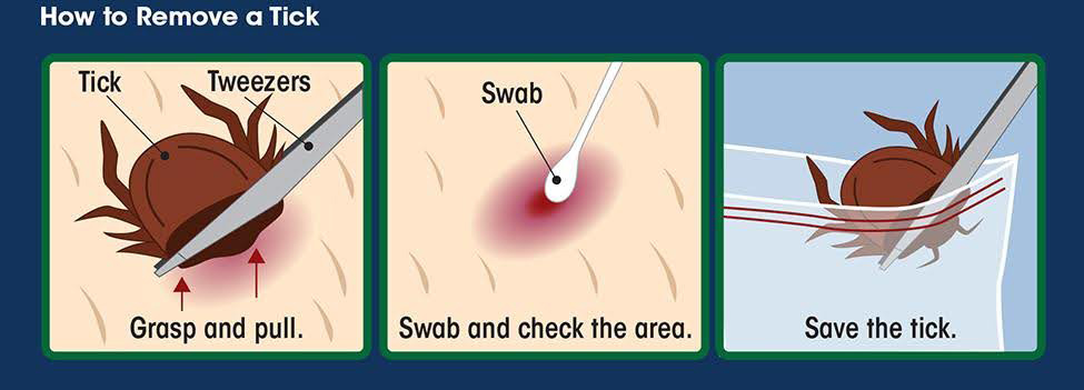 How to remove a tick: grasp it with tweezers and pull, swab and check the area, and save the tick in a sealed bag